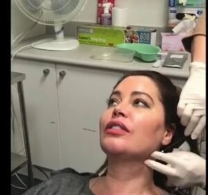  Dermal fillers