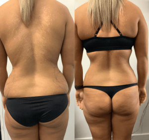 Liposuction Australia Health & Medical in South Yarra