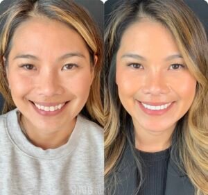 Dental Clinics in Victoria Australia Dental & Skin Clinic - Porcelain Veneers