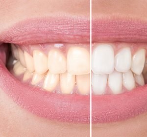  Pain Free Dentist Sydney - Dentist Dulwich Hill