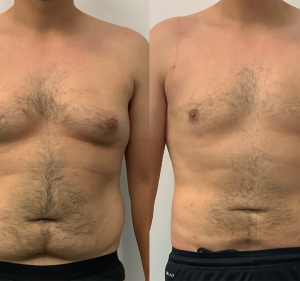 Cosmetic Surgery Clinics in South Yarra Australia Liposuction Australia