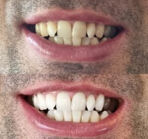 Dental Clinics in Victoria Australia Teeth Whitening Melbourne