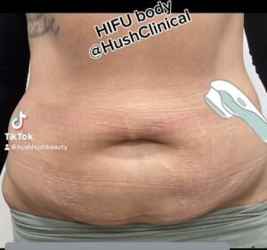 Hush Clinical - HIFU Health & Medical in South Yarra